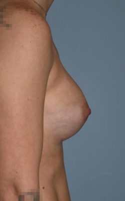 Breast Augmentation
