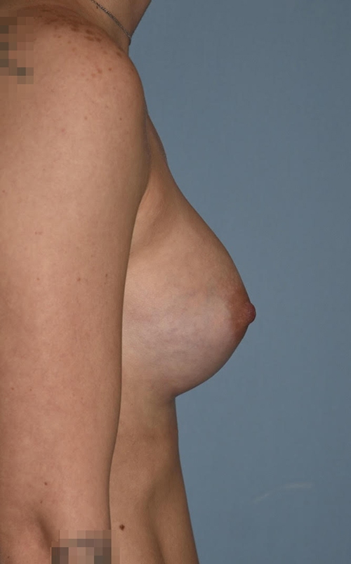 Breast Augmentation