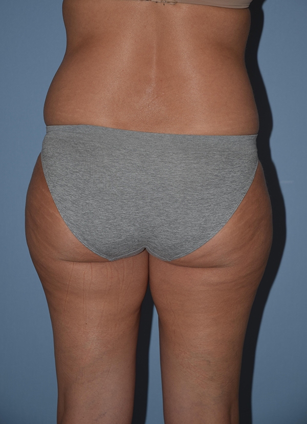 Liposuction