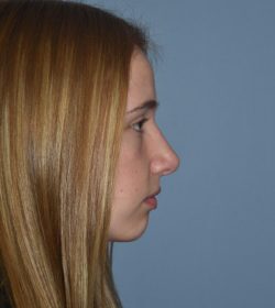 Rhinoplasty