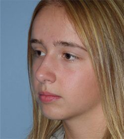 Rhinoplasty