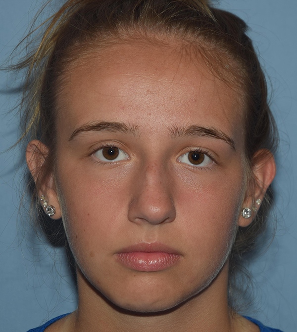 Rhinoplasty Case 1230 Before Photo Rhinoplasty