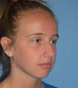 Rhinoplasty