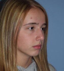 Rhinoplasty