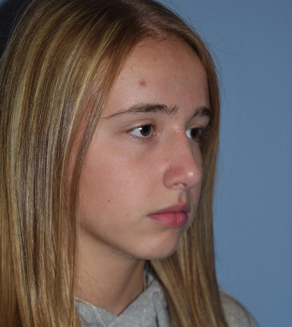 Rhinoplasty