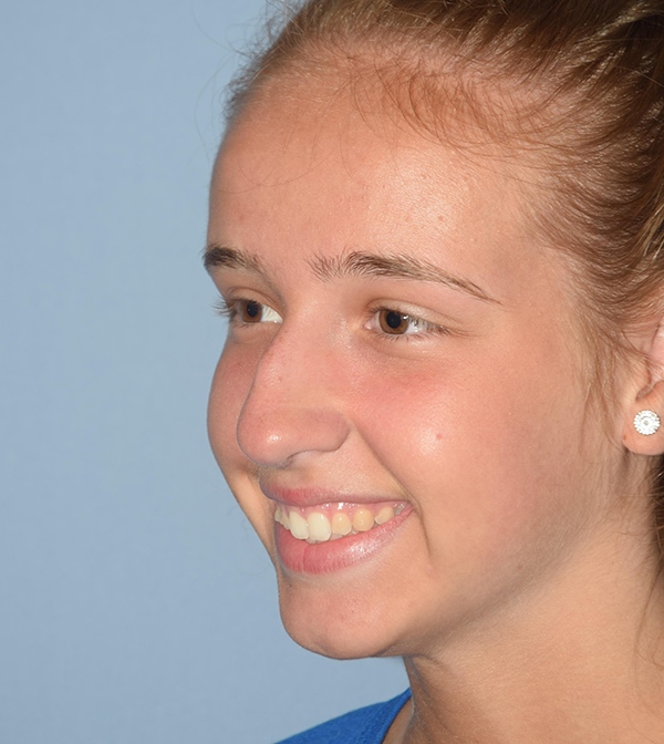 Rhinoplasty