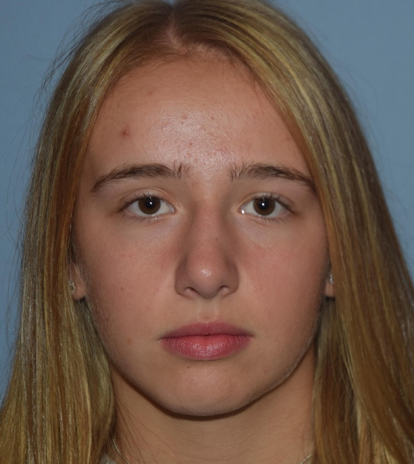 Rhinoplasty Case 1230 After Photo Rhinoplasty