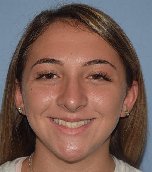 Rhinoplasty