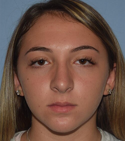 Rhinoplasty Case 1315 After Photo Rhinoplasty
