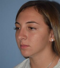 Rhinoplasty