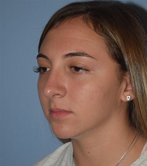 Rhinoplasty