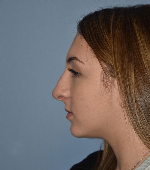 Rhinoplasty