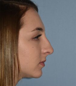 Rhinoplasty
