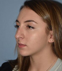 Rhinoplasty