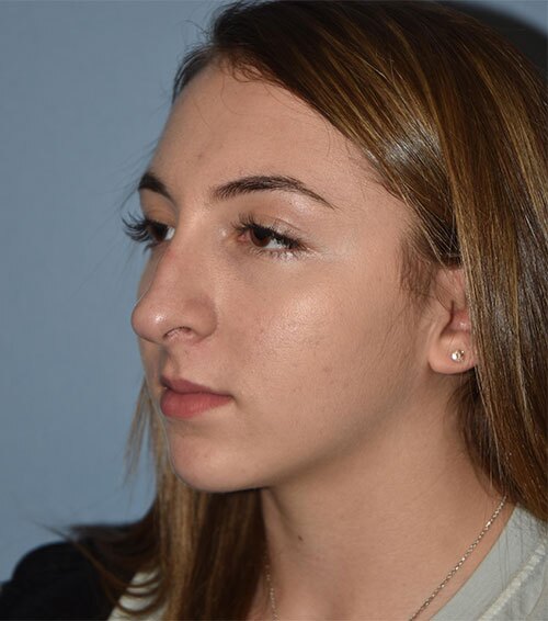 Rhinoplasty