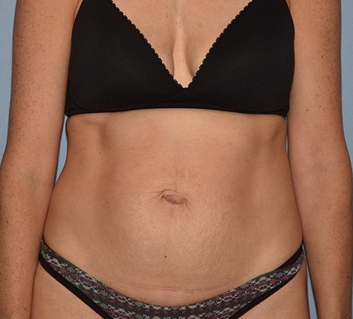 Tummy tuck before and after image