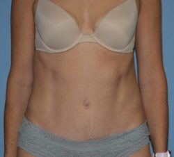 Tummy Tuck