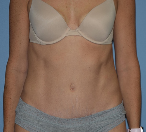 Abdominoplasty results photo
