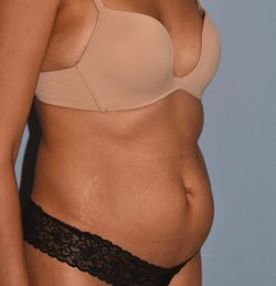 Tummy Tuck