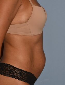Tummy Tuck