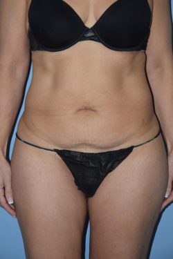 Tummy Tuck