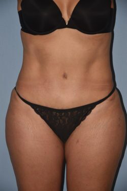 Tummy Tuck