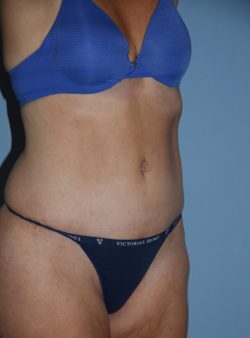 Tummy Tuck