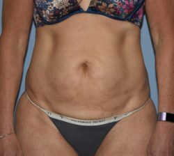 Tummy Tuck