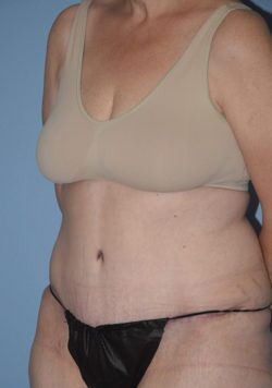Tummy Tuck