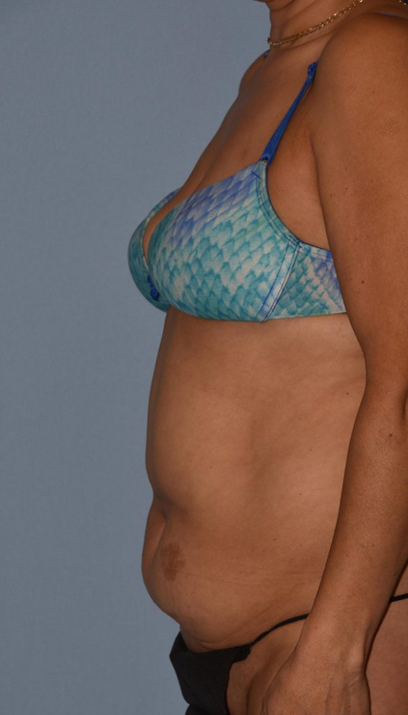 Tummy Tuck Case 1208 Before Photo Tummy Tuck