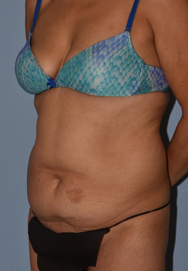 Tummy Tuck Case 1208 Before Photo Tummy Tuck