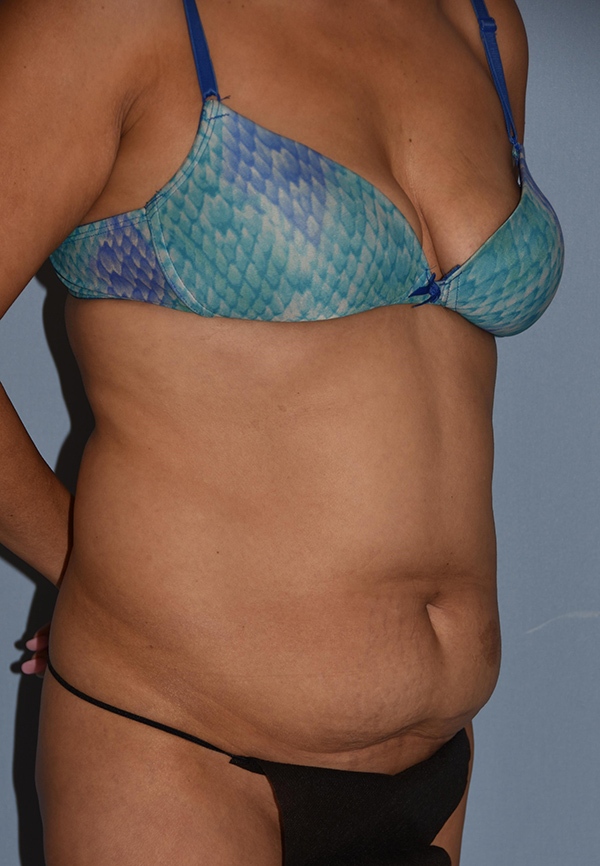 Tummy Tuck Case 1208 Before Photo Tummy Tuck
