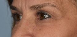 Upper Eyelid Blepharoplasty