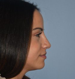 Rhinoplasty