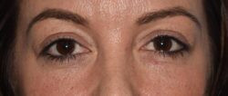 Upper Eyelid Blepharoplasty