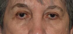Upper Eyelid Blepharoplasty