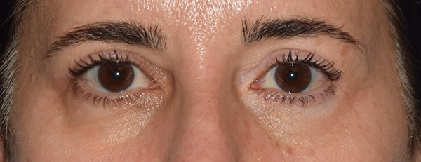 Upper Eyelid Blepharoplasty Case 1454 After Photo Upper Eyelid Blepharoplasty