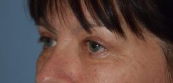 Upper Eyelid Blepharoplasty