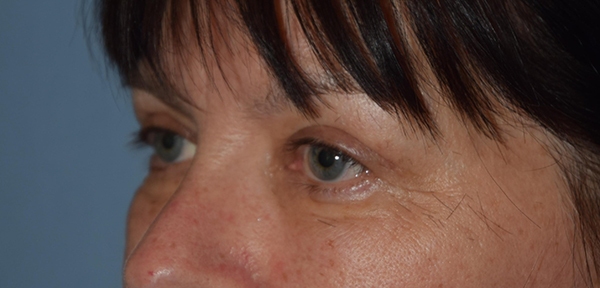 Upper Eyelid Blepharoplasty