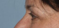 Upper Eyelid Blepharoplasty