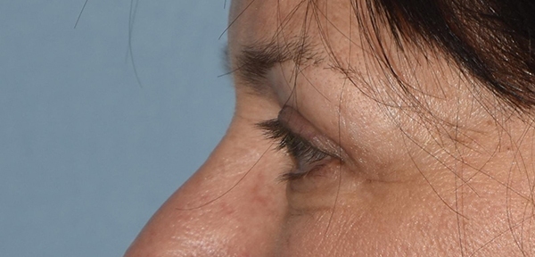 Upper Eyelid Blepharoplasty