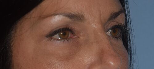 Blepharoplasty