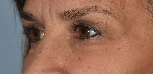 Upper Eyelid Blepharoplasty