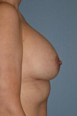 Breast Augmentation