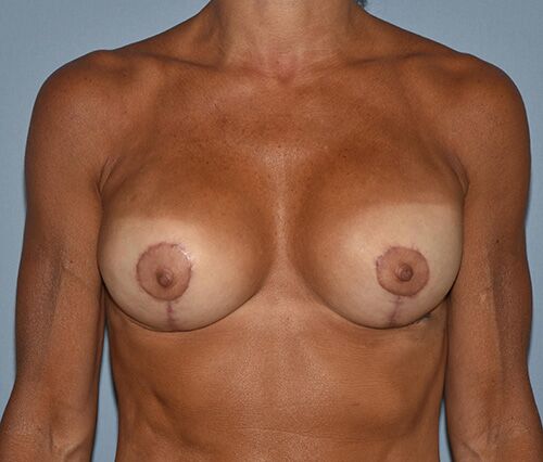 Breast Reconstruction (Implants) Case 847 After Photo Breast Reconstruction (Implants)