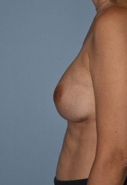 Breast Reconstruction (Implants)