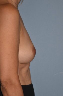 Breast Reconstruction (Implants)