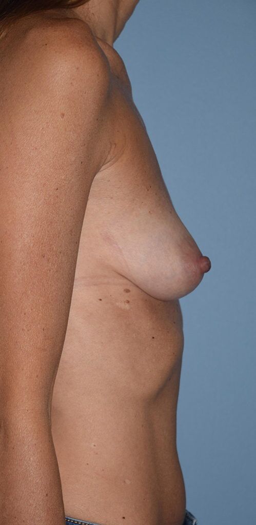Breast Reconstruction (Implants)
