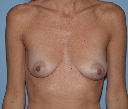 Breast Reconstruction (Implants) Case 865 Before Photo Breast Reconstruction (Implants)