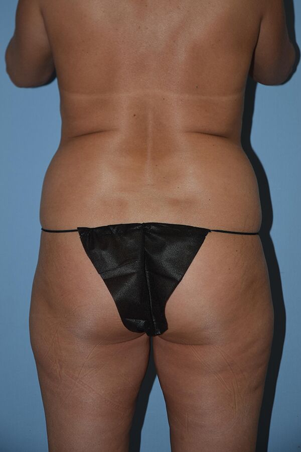 Liposuction